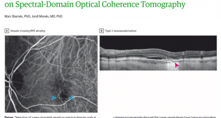 Direct Visualization of a New Choroidal Vessel...