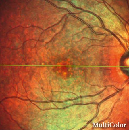 Gain Characterization Of Geographic Atrophy Progression In Patients