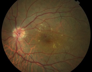 RD edema macular