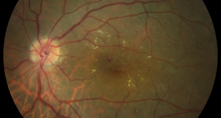 RD edema macular