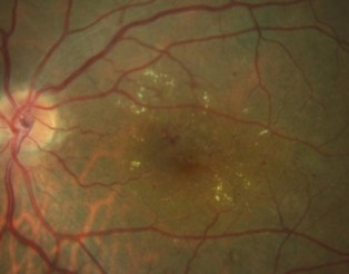 Edema macular diabético