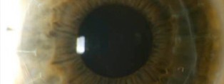 opacidad-corneal