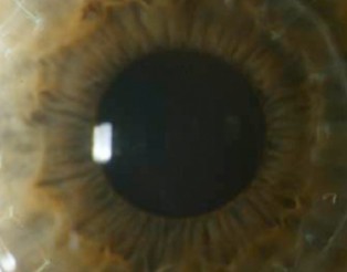 opacidad-corneal