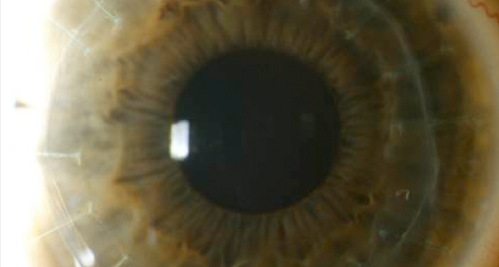 opacidad-corneal