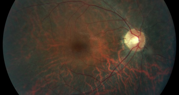 retinosi pigmentaria